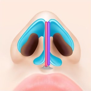 코 내부 해부 일러스트 — 곧게 편 비중격연골 옆에 연골 조각을 나란히 덧대 연골지지대를 보강한 상태