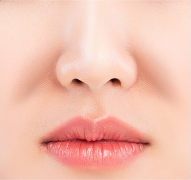 수술 전 — 코와 인중, 입술 주변을 클로즈업한 얼굴 중앙 하부. 팔자 부위가 평평하게 꺼져 있다.