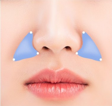 같은 부위에 양쪽 비순구를 따라 반투명 파란색 삼각형으로 표시한 맞춤 보형물 삽입 위치.