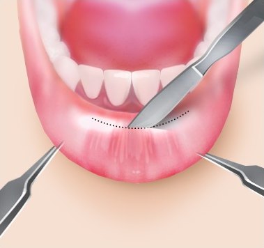 입술내측 절개 — 입 안쪽 점막에 점선 절개선과 수술기구가 표시된 일러스트