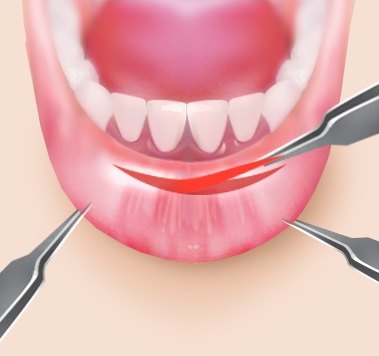 점막 일부 제거 — 아랫입술 안쪽 점막을 절제하는 일러스트