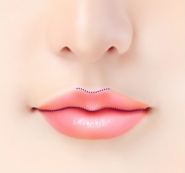 수술 후 — 입술꼭지가 돌출된 M자 라인이 점선으로 표시된 입술 클로즈업 일러스트
