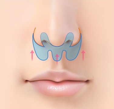 인중 윗부분 절개 — 코 밑 물결 절개선과 위로 향한 화살표가 표시된 일러스트