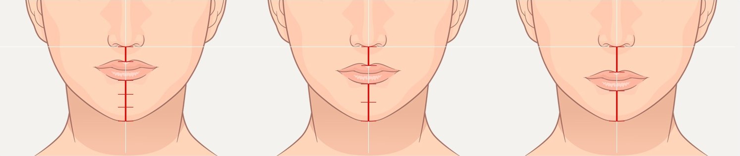 인중 길이가 다른 세 하안면 일러스트 — 짧은 인중, 정상적인 인중, 긴 인중의 코·입술·턱 비율 비교