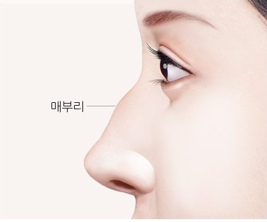 매부리가 있는 여성 옆얼굴 일러스트 — 수술 전 (라벨: 매부리)