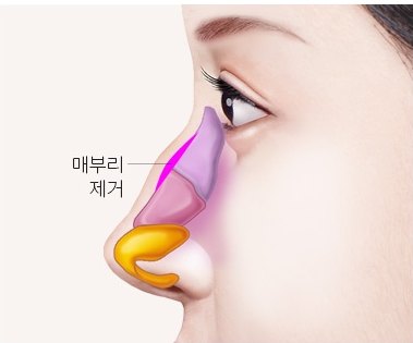 매부리 부위를 제거하는 과정을 색으로 표시한 옆얼굴 일러스트 (라벨: 매부리 제거)