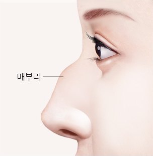 심한 매부리가 있는 여성 옆얼굴 일러스트 — 수술 전 (라벨: 매부리)