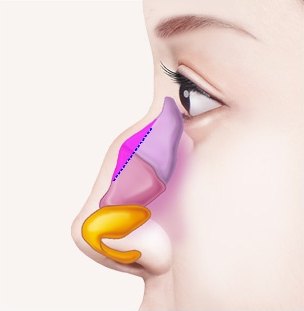 코뼈와 연골의 절골 범위를 색과 점선으로 표시한 옆얼굴 일러스트