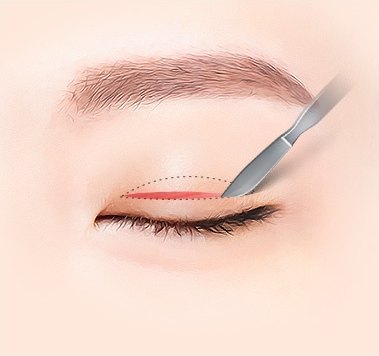 점선 디자인을 따라 메스로 눈꺼풀을 절개하는 일러스트