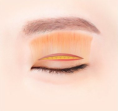 상안검거근 섬유와 절개창을 노란 봉합사로 고정해 봉합하는 일러스트