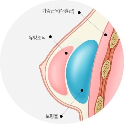 보형물이 유방조직 아래·가슴근육 위에 놓인 상태를 보여주는 가슴 단면 해부 도해 — 라벨 ‘가슴근육(대흉근)’, ‘유방조직’, ‘보형물’