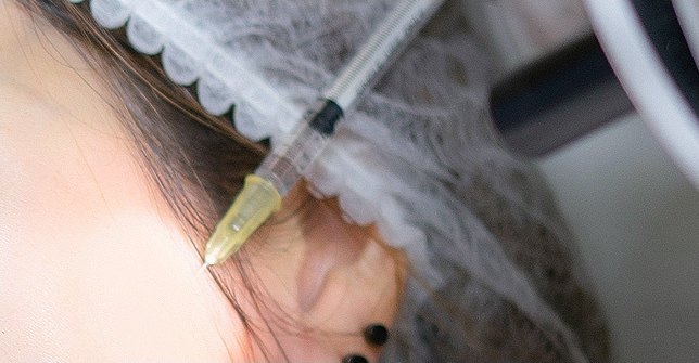 수술캡을 쓴 여성의 관자놀이 부근에 주사기를 대고 있는 시술 장면