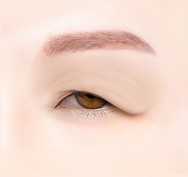 처지고 주름진 눈꺼풀을 뜬 눈 클로즈업 일러스트 — 수술 전 상태
