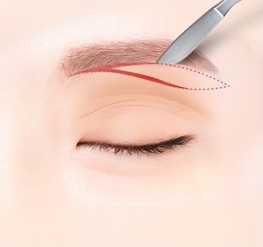 메스가 눈썹 아래 절개선을 따라 절개하는 일러스트