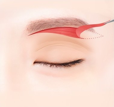 붉게 표시된 늘어진 눈꺼풀 피부를 제거하는 일러스트