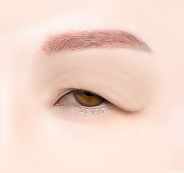 수술 전 — 처지고 주름진 눈꺼풀 일러스트