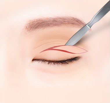 눈꺼풀 디자인 후 절개 — 절개선 디자인과 메스 일러스트
