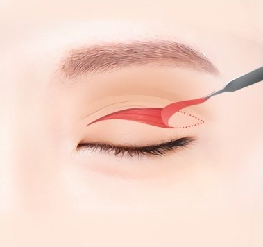 늘어진 피부 제거 — 절개된 피부를 들어올리는 일러스트