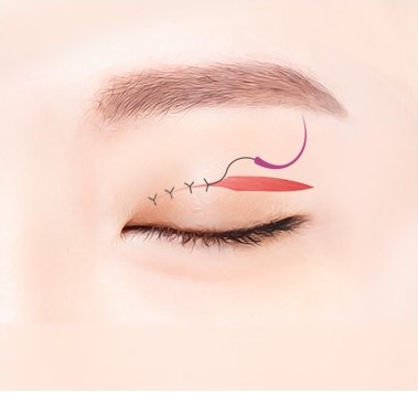 섬세 봉합 — 곡선 바늘과 실로 봉합하는 일러스트