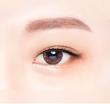 수술 후 — 또렷하게 교정된 눈매 일러스트