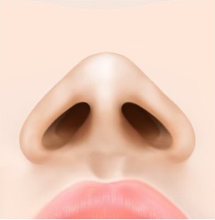 넓게 벌어진 콧볼 상태의 코 정면 일러스트 — 수술 전
