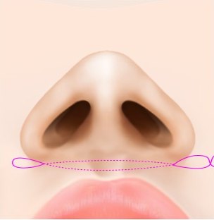 콧구멍 아래쪽을 실로 묶는 경로를 표시한 코 일러스트