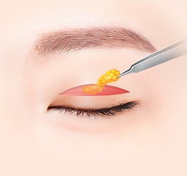 절개한 윗눈꺼풀에서 노란 지방을 핀셋으로 집어 제거하는 일러스트