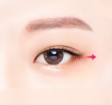 견고하게 고정한 뒤 봉합하는 과정 일러스트