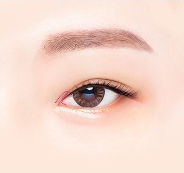 몽고주름 윗부분을 절개하는 과정 일러스트