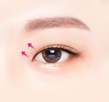 절개라인이 보이지 않도록 봉합하는 과정 일러스트