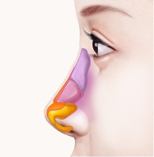 날개연골 박리 — 코끝 날개연골을 박리하는 과정 일러스트