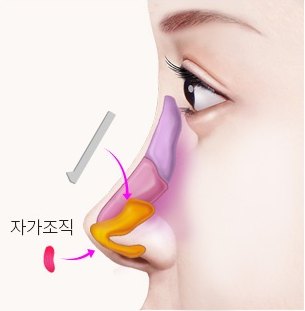 자가조직 삽입 — 보형물과 함께 넣을 자가조직 조각에 '자가조직' 지시 라벨이 표시된 일러스트
