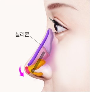콧대, 코끝 교정 — 콧등에 놓인 보형물에 '실리콘' 지시 라벨이 표시된 일러스트