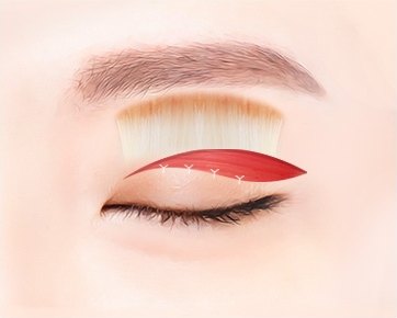 상안검 수술 — 윗눈꺼풀 절개선과 제거 범위를 붉은 색면으로 표시한 눈 클로즈업 일러스트