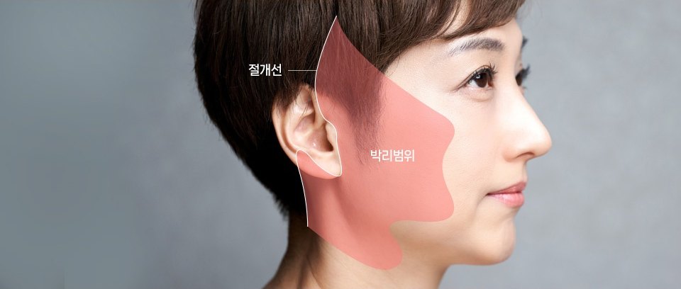 여성의 좌측 옆얼굴에 안면거상 박리 범위를 반투명 붉은 면으로, 절개 경로를 흰 선으로 표시한 해부 도해. 도해에는 '절개선'과 '박리범위' 라벨이 표기되어 있다